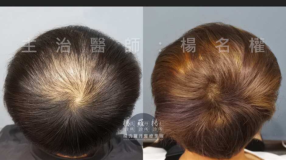 生髮613,六合一三階段雄性禿治療,生髮,落髮,掉髮