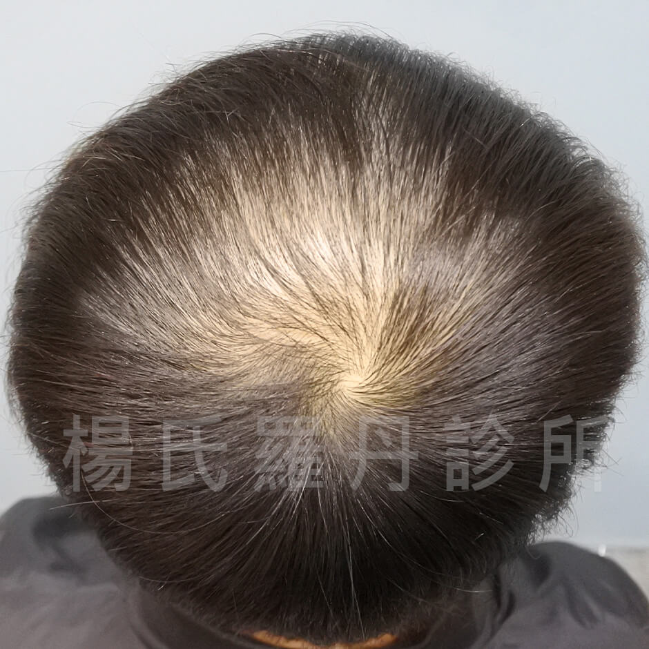 生髮613,張泰山生髮,生髮,落髮,掉髮