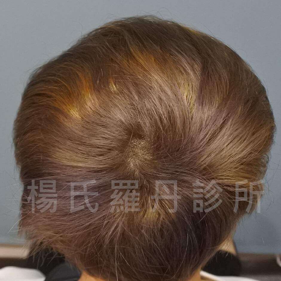 三階段雄性禿治療生髮,落髮,掉髮,張泰山頭髮