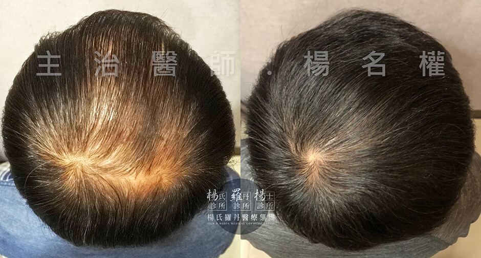 生髮,複合式生髮,生髮613