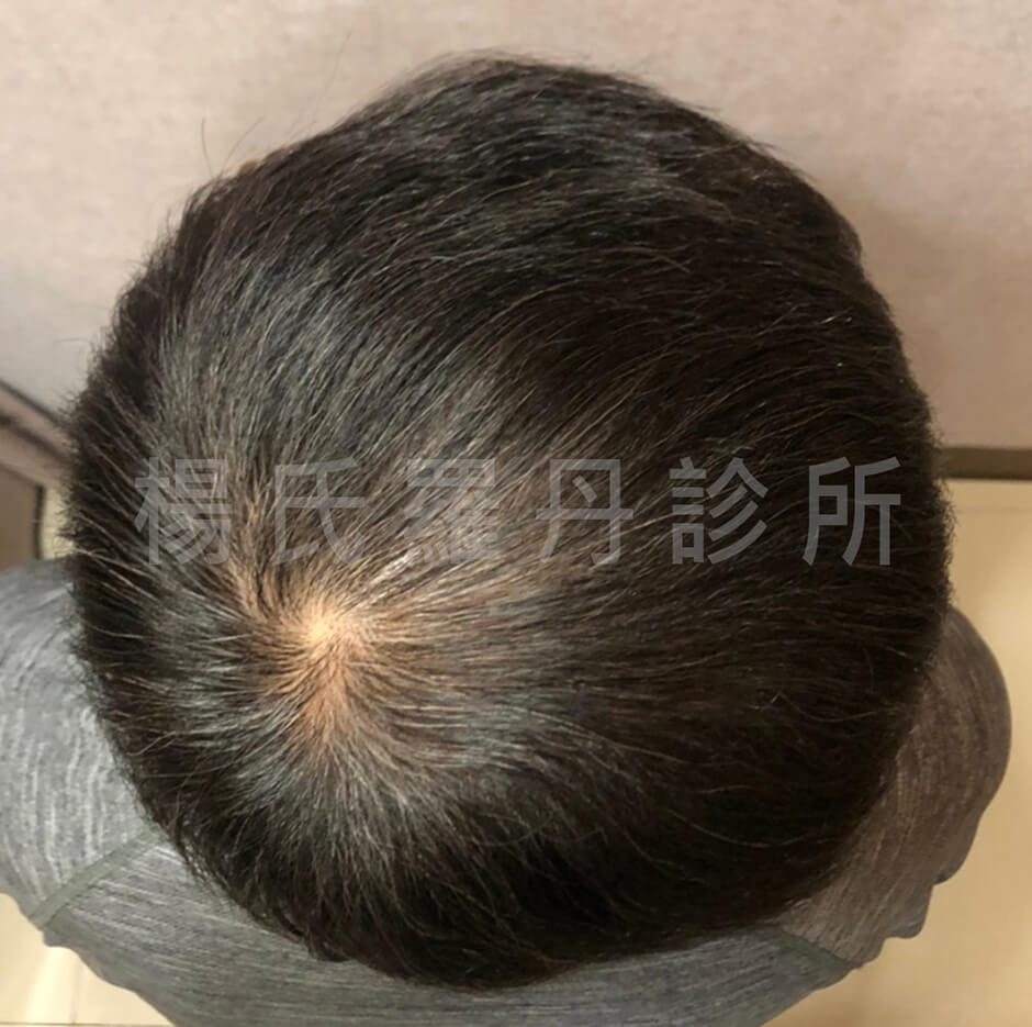 六合一三階段雄性禿治療,生髮,複合式生髮