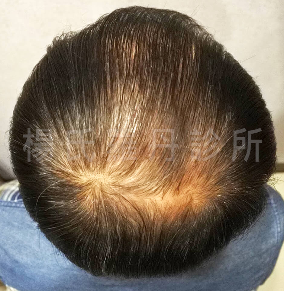 生髮,複合式生髮,生髮613