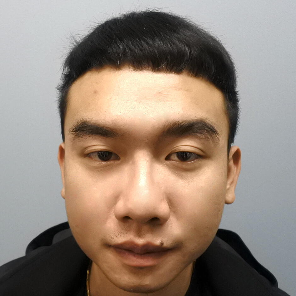 植髮,生髮613,生髮療程,掉髮,生髮