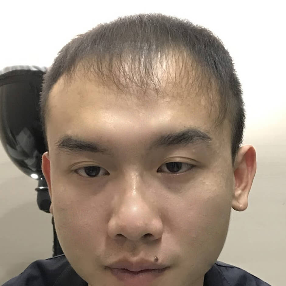 植髮,生髮,生髮療程,生髮613,落髮