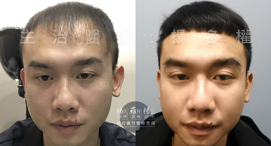 六合一三階段雄性禿治療 植髮,生髮,生髮療程