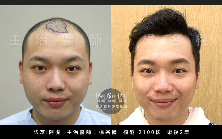 植髮,複合式生髮,阿虎,楊名權,楊氏羅丹,楊氏診所,掉髮,落髮,雄性禿,異常落髮