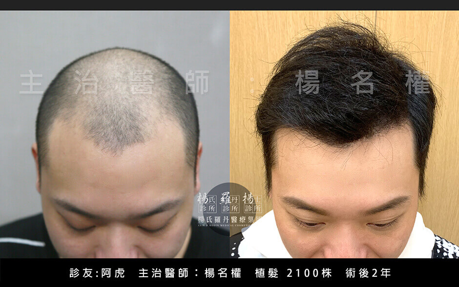 植髮,複合式生髮,阿虎,楊名權,楊氏羅丹,楊氏診所,掉髮,落髮,雄性禿,異常落髮