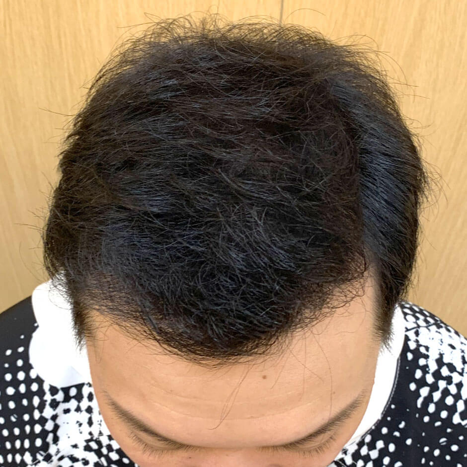 植髮,雄性禿,楊氏羅丹,台北植髮,植鬍,植眉,掉髮,落髮,楊名權,李定懋