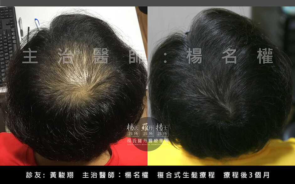 生髮613 植髮,複合式生髮,楊氏羅丹