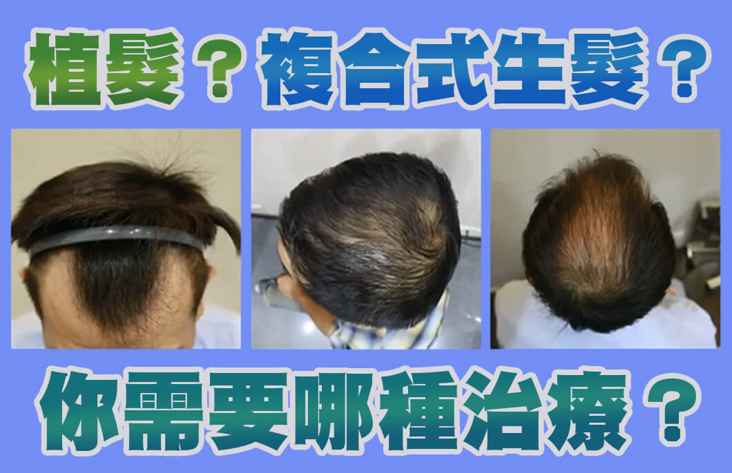 植髮,複合式生髮,六合一三階段雄性禿治療,落髮,雄性禿