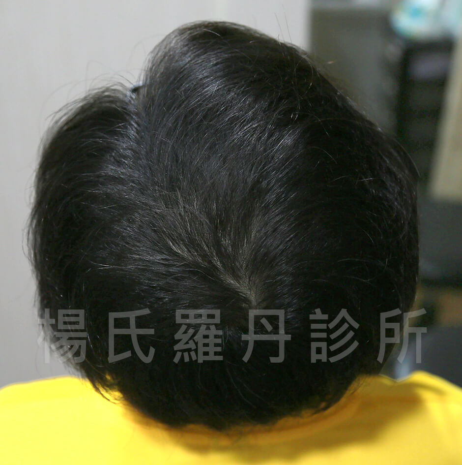 生髮,六合一三階段雄性禿治療,禿頭,楊氏羅丹