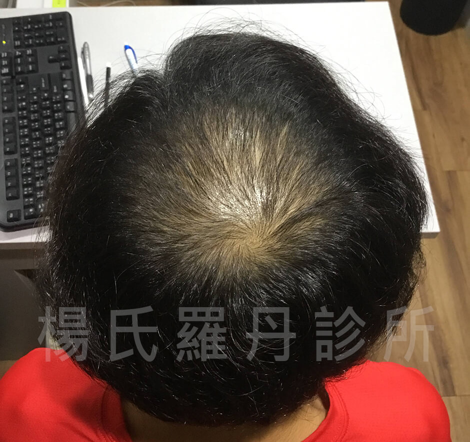 生髮,黃駿翔,禿頭,生髮613