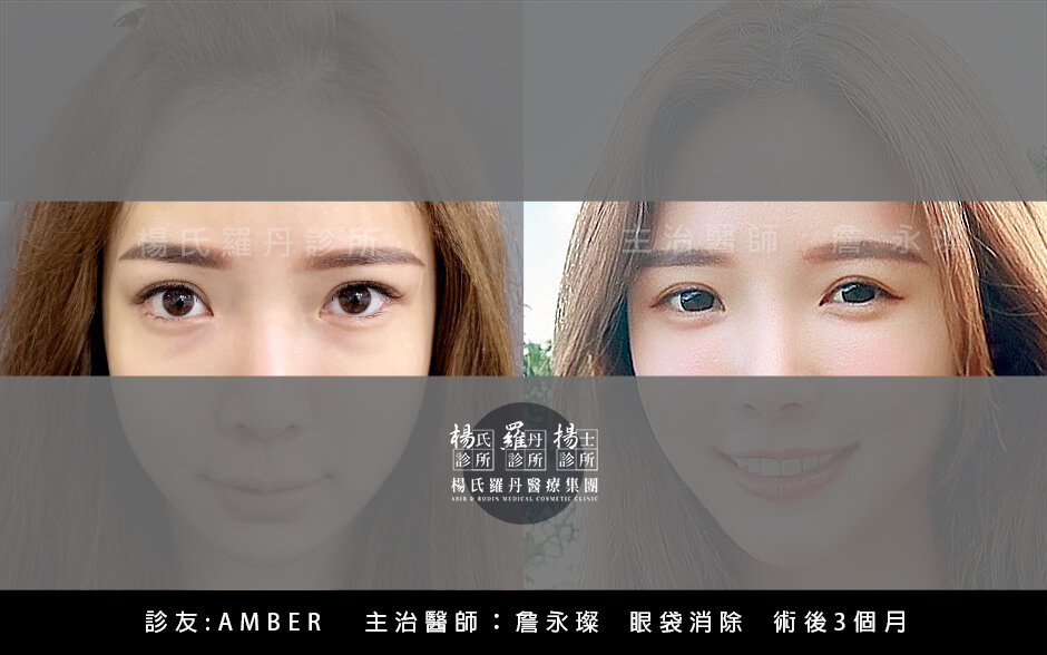 眼袋-星蕾-眼袋消除-隱痕眼袋消除-楊氏羅丹