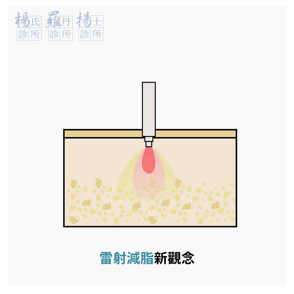 瘦手臂-抽脂-雷射減脂