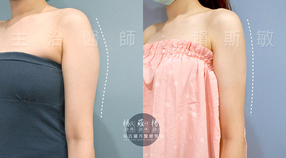 雷射減脂 手臂 瘦手臂