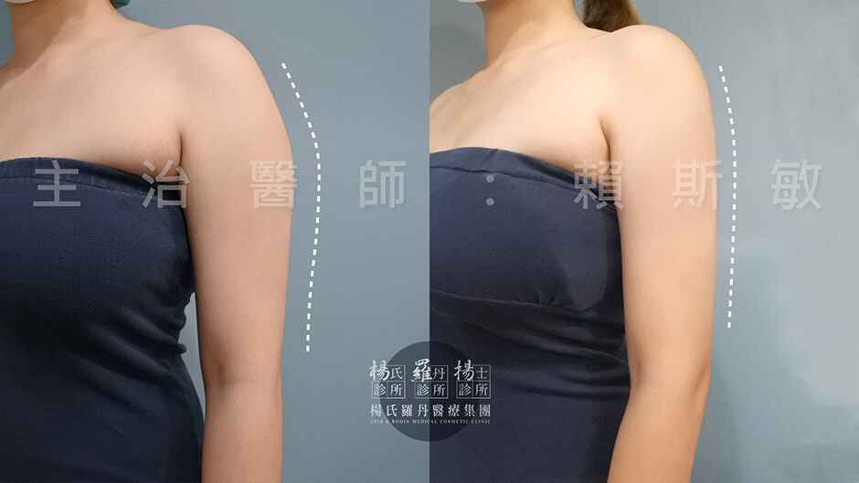 瘦手臂 雷射減脂