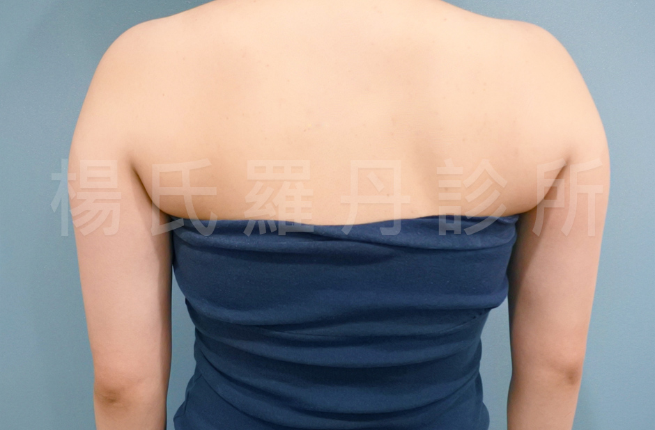 瘦手臂 雷射減脂 楊氏羅丹