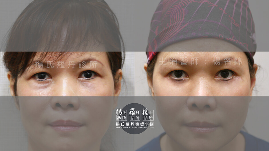 醫學美容 楊氏羅丹 眼袋  眼袋手術