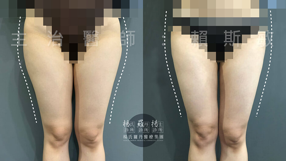 減脂手術 瘦大腿 贅肉 楊氏羅丹