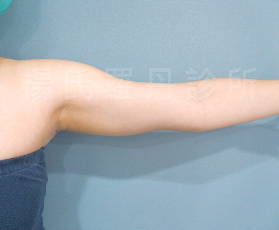 雷射減脂 手臂 瘦手臂