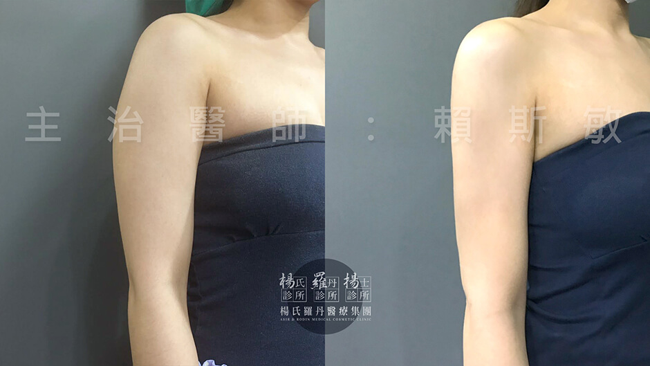 楊氏羅丹 雷射減脂 手臂