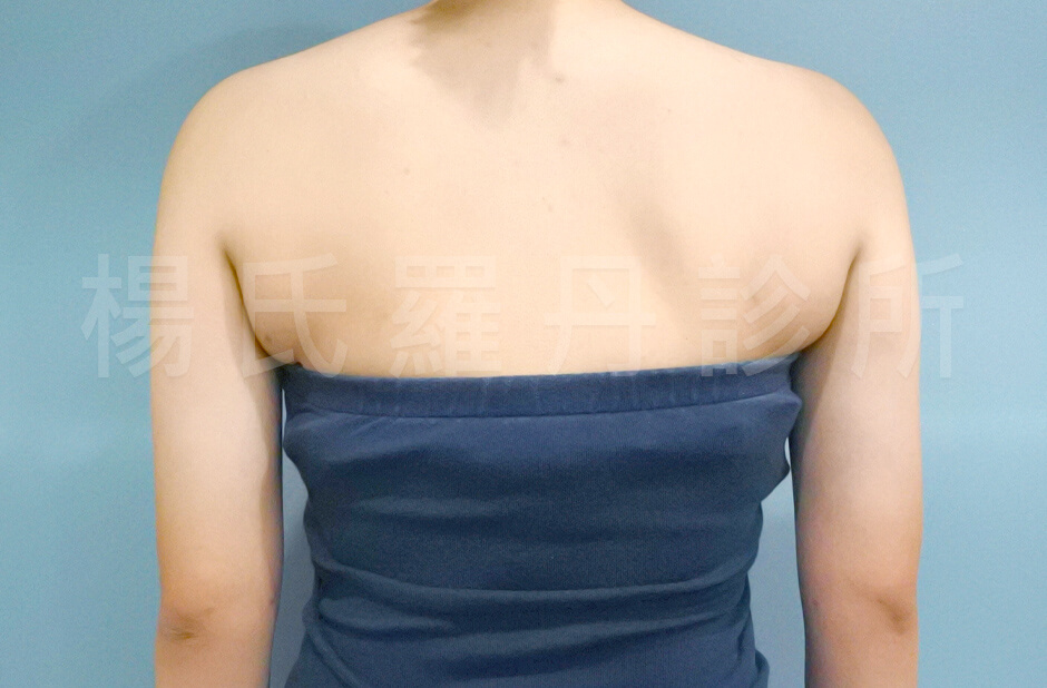 楊氏羅丹 雷射減脂 手臂