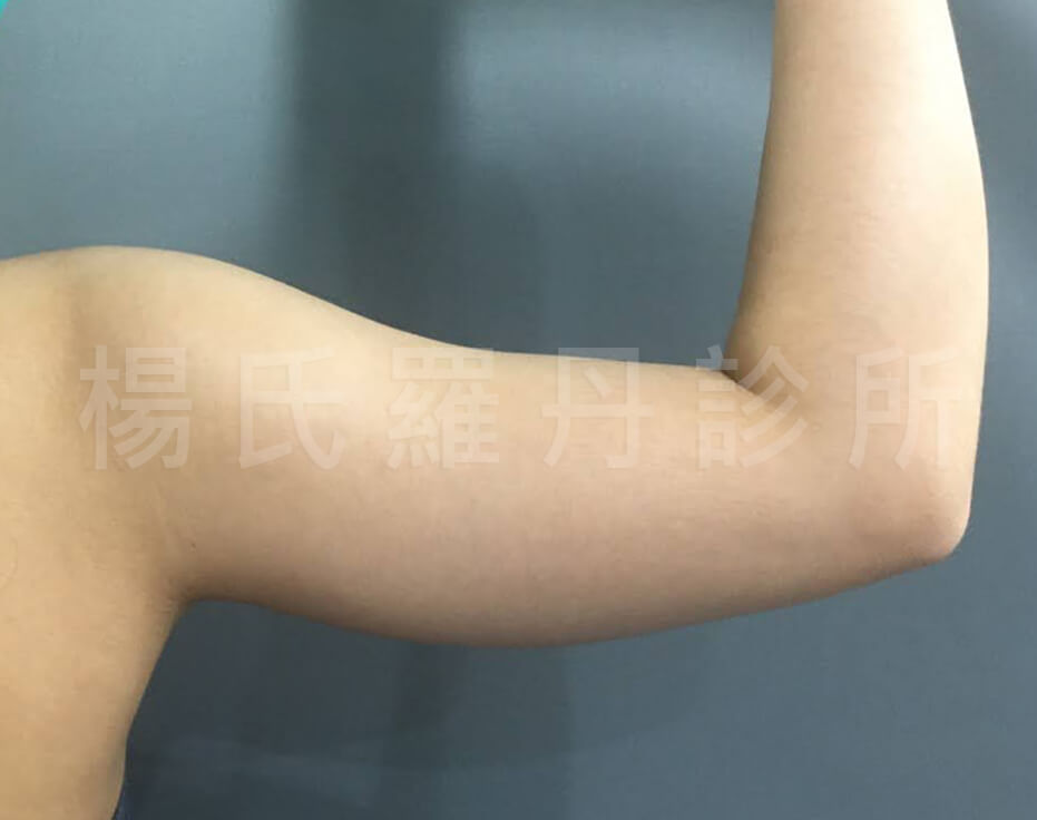 雷射減脂 贅肉 手臂