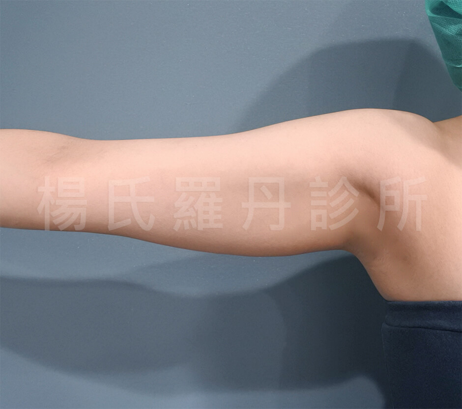 手臂 雷射減脂 瘦手臂