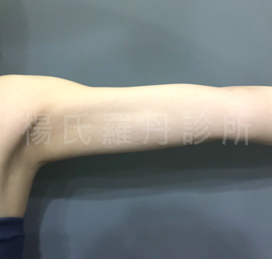 手臂 雷射減脂 楊氏羅丹