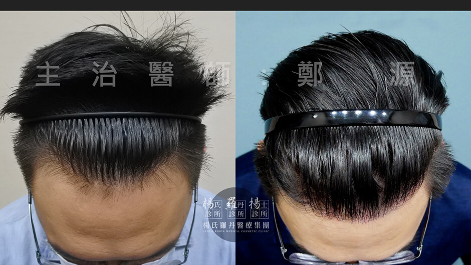 植髮手術 楊氏羅丹