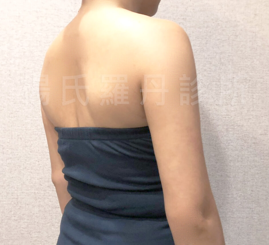 瘦手臂 雷射減脂 蝴蝶袖