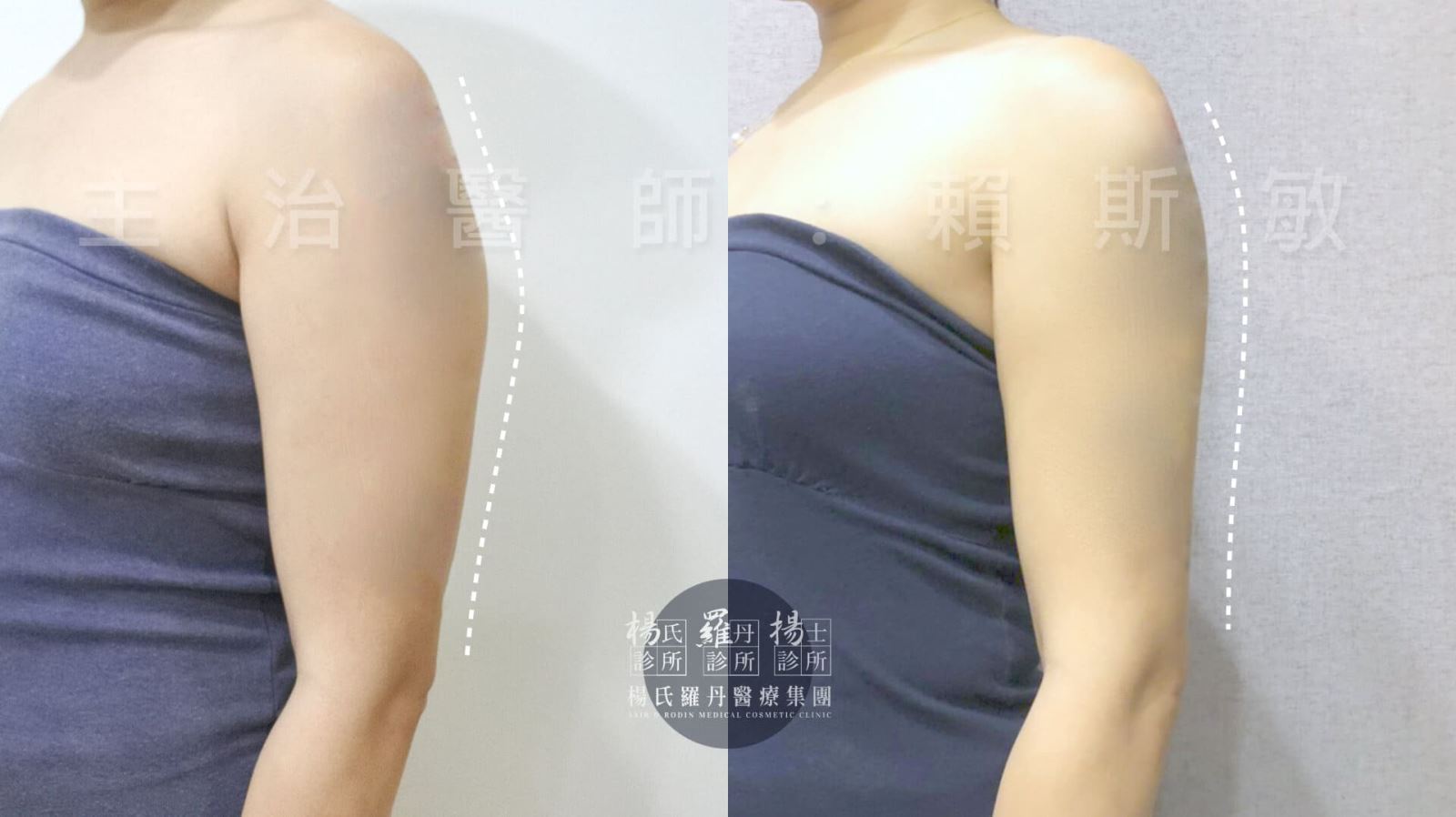 減脂手術 雷射減脂 蝴蝶袖