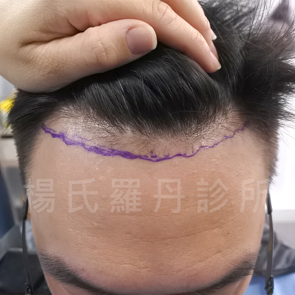 禿頭 植髮 掉髮