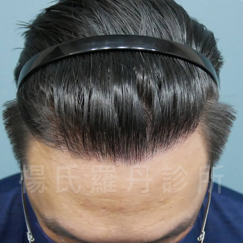 植髮 掉髮 髮際線
