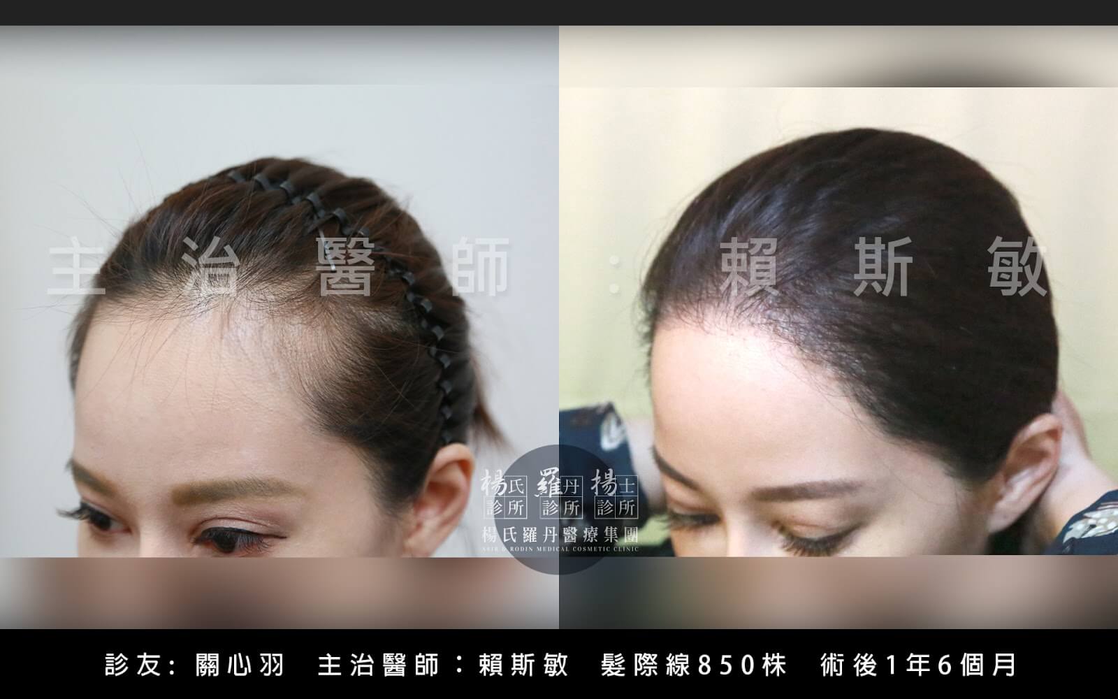 生髮成功案例：女性植髮案例