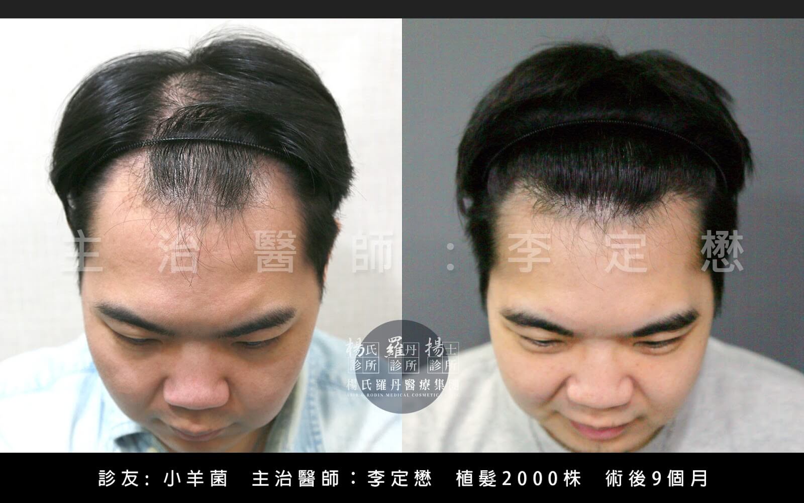 生髮成功案例：M型禿