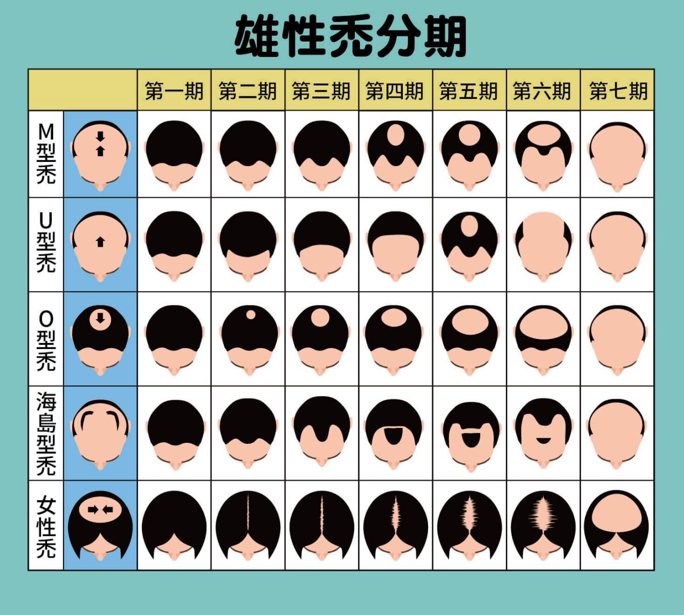 生髮療程治療雄性禿