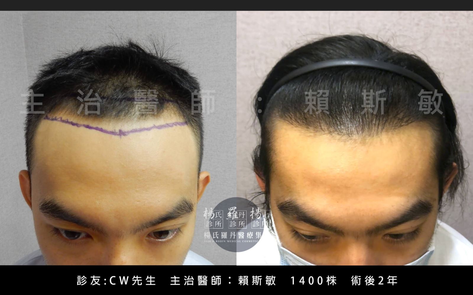 楊氏羅丹的賴醫師幫助頭髮恢復正常髮線