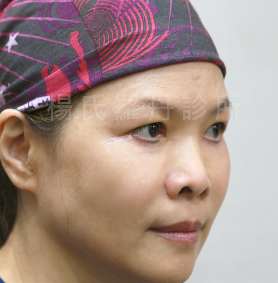 眼袋淚溝 黑眼圈 楊氏羅丹