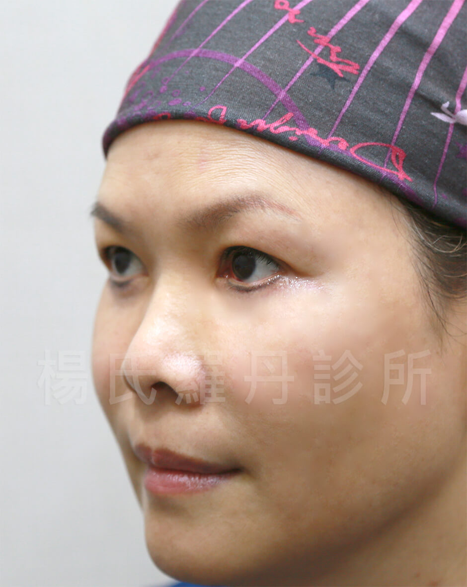 淚溝 眼袋 贅皮 醫學美容