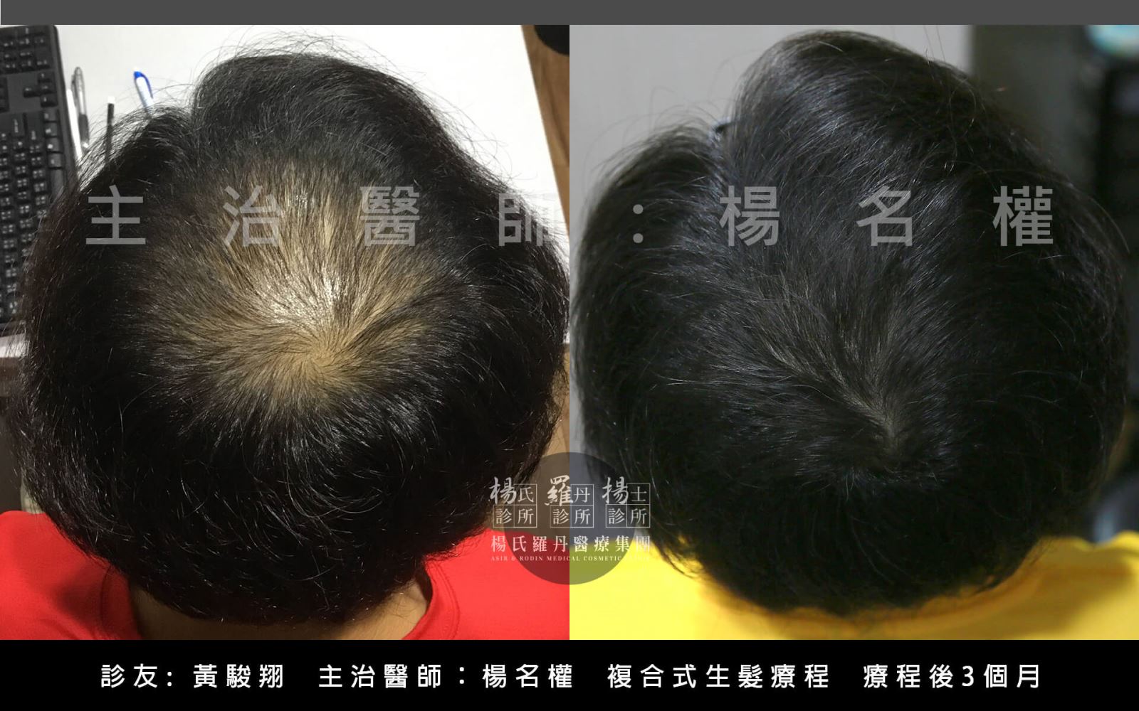 地中海治療方式:楊氏羅丹植髮療程 生髮613