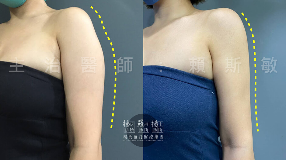 雷射減脂 抽脂 抽脂推薦