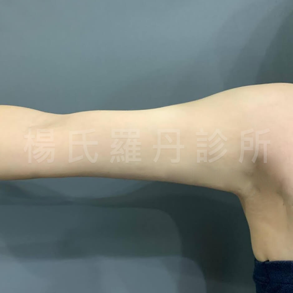 瘦手臂 雷射減脂