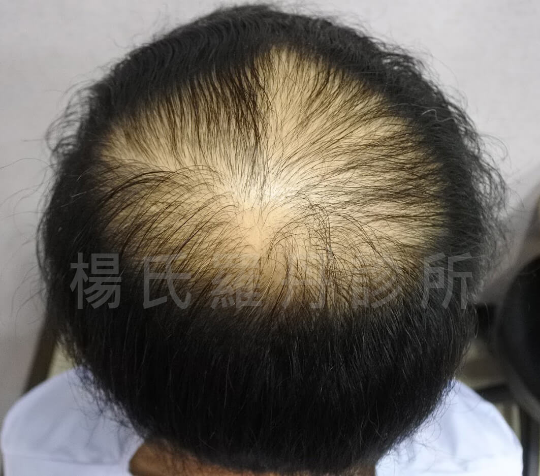 禿頭 掉髮 生髮613