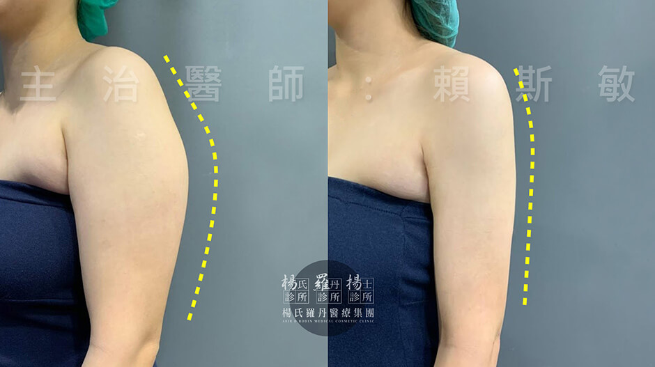 雷射減脂 蝴蝶袖