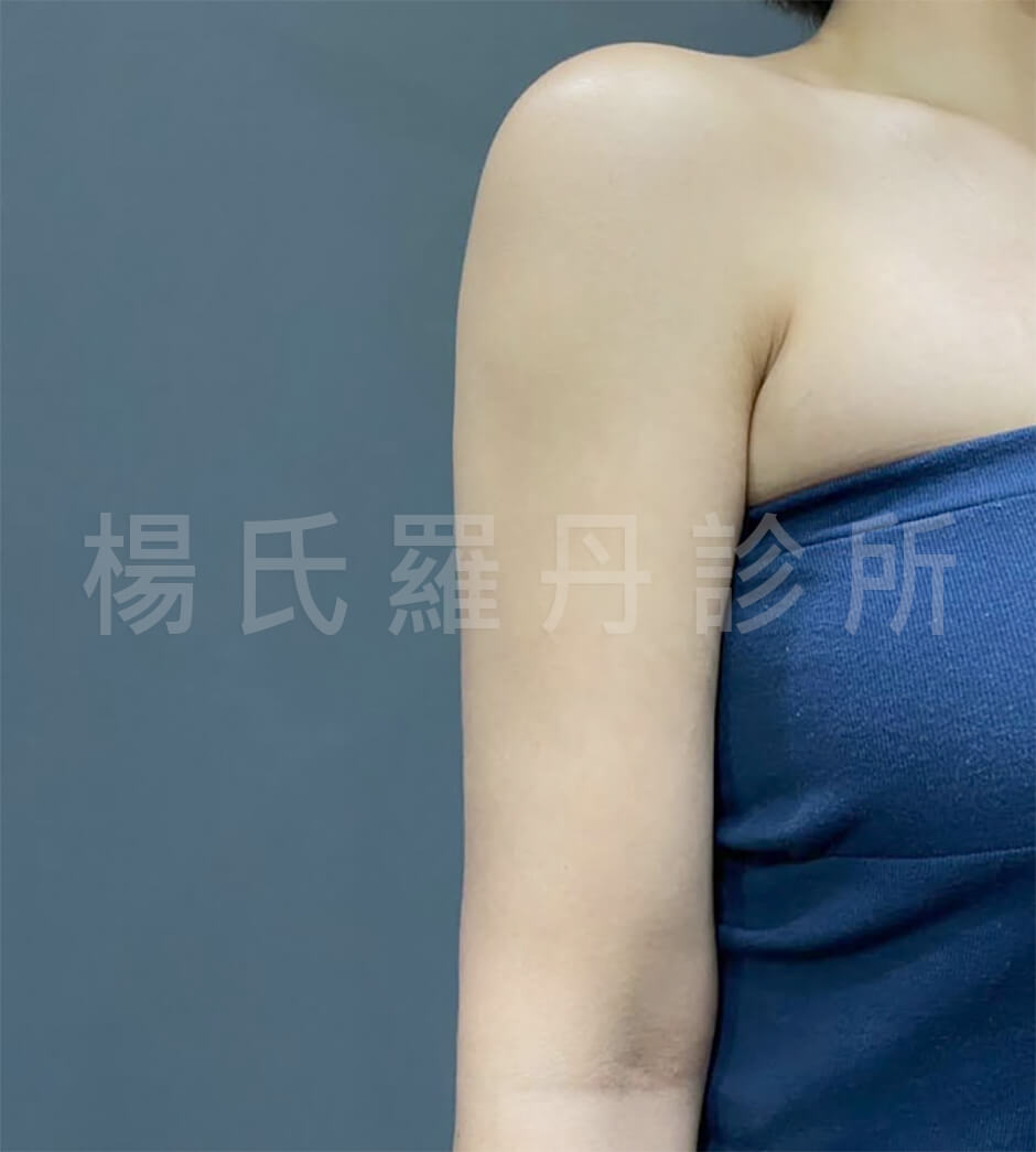 瘦手臂 楊氏羅丹 雷射減脂