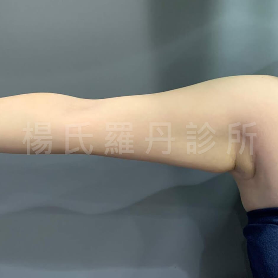 贅肉 手臂