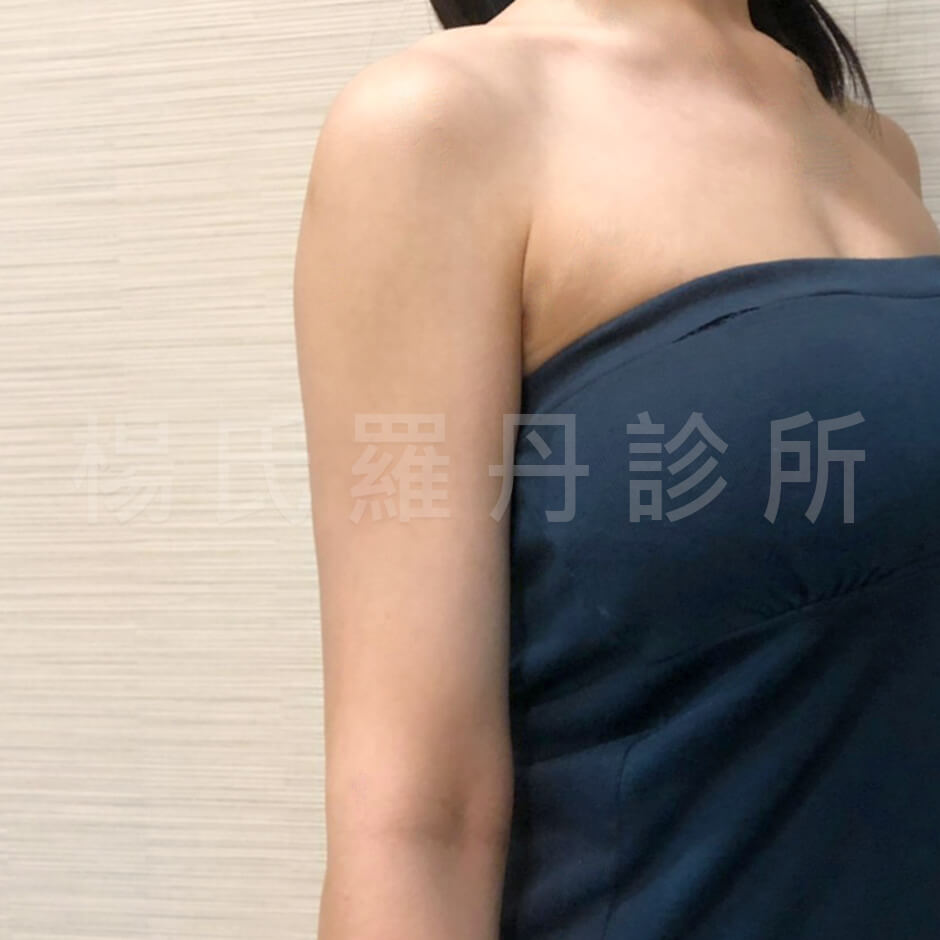 蝴蝶袖 瘦手臂