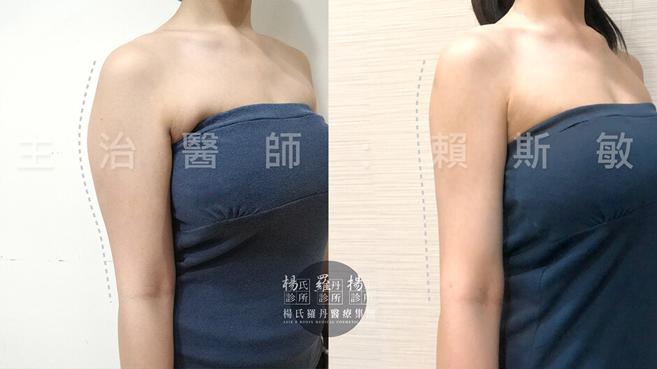 瘦手臂 楊氏羅丹 雷射減脂