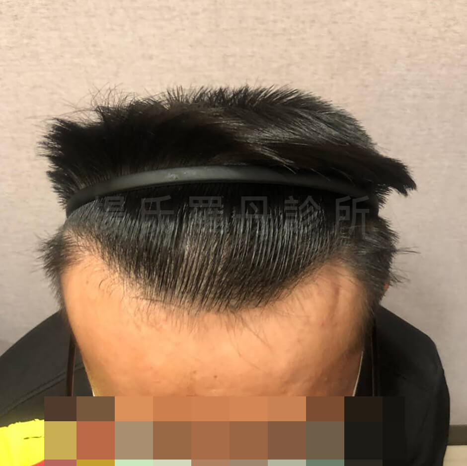 生髮  改善落髮 禿頭